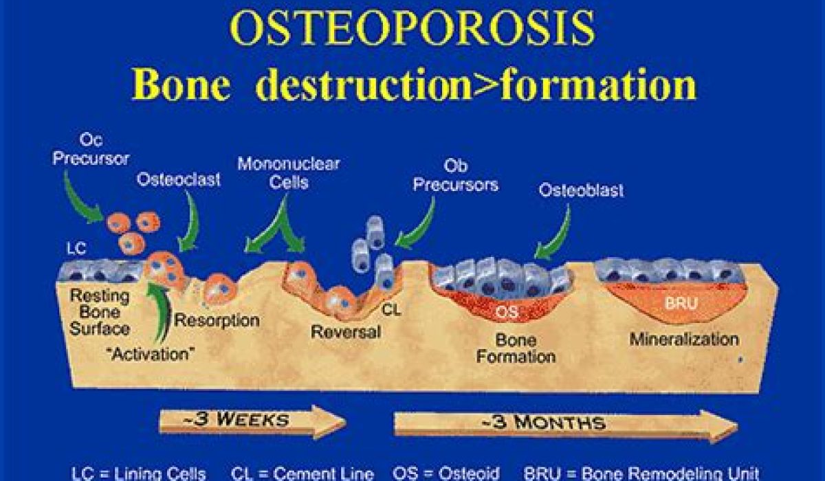True Or False Bone Formation Exceeds Bone Resorption In Osteoporosis