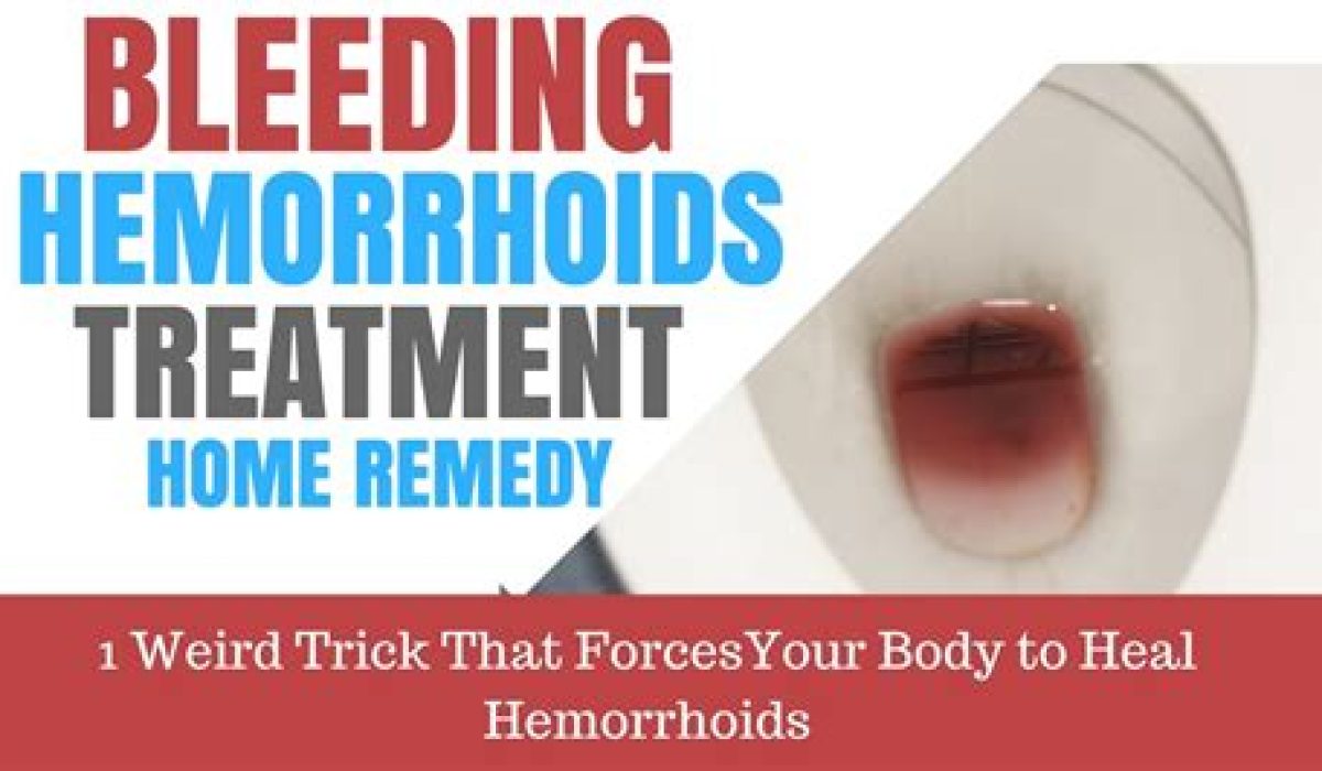 How To Stop Bleeding Hemorrhoids